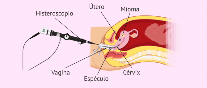 Imagen: Histeroscopia para extraer un mioma
