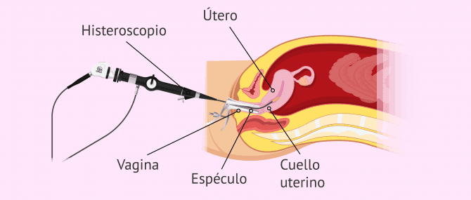 Imagen: histeroscopia-definicion