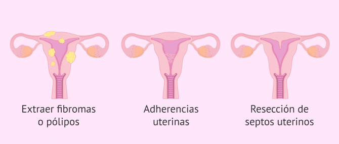 Imagen: Casos en los que están indicados la histeroscopia