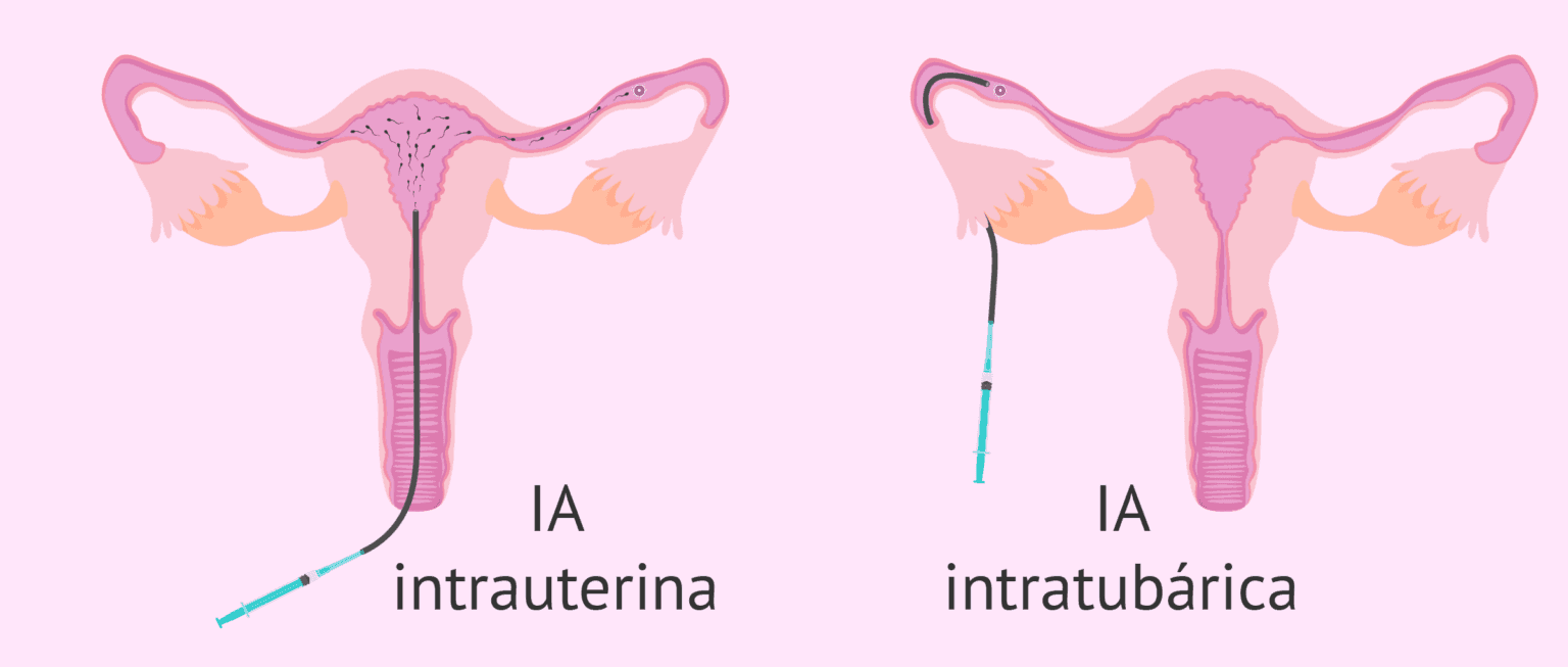 IA Intrauterina O Intratub rica