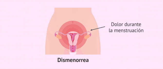 Imagen: Imagen de dismenorrea