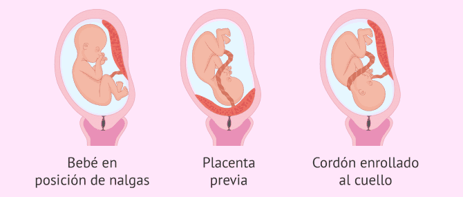 Imagen: Indicaciones fetales de una cesárea
