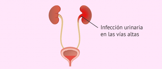 Imagen: Infección urinaria de las vías altas