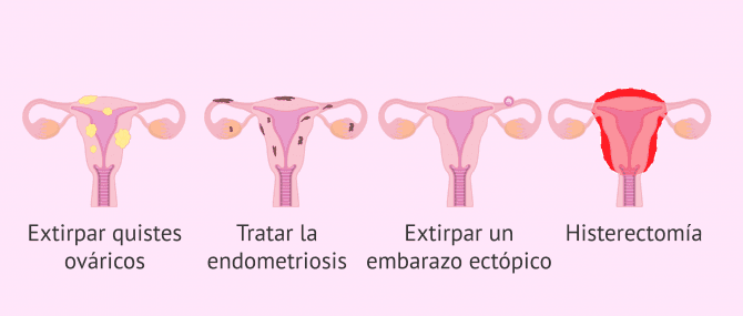 Imagen: Inidicaciones de la laparoscopia quirúrgica