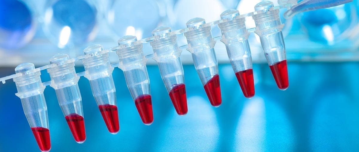Leucemia linfoblástica del lactante