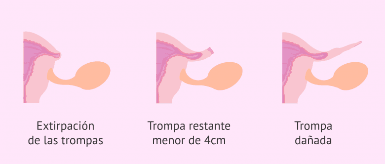 Imagen: Ligadura de trompas Imposible de revertir