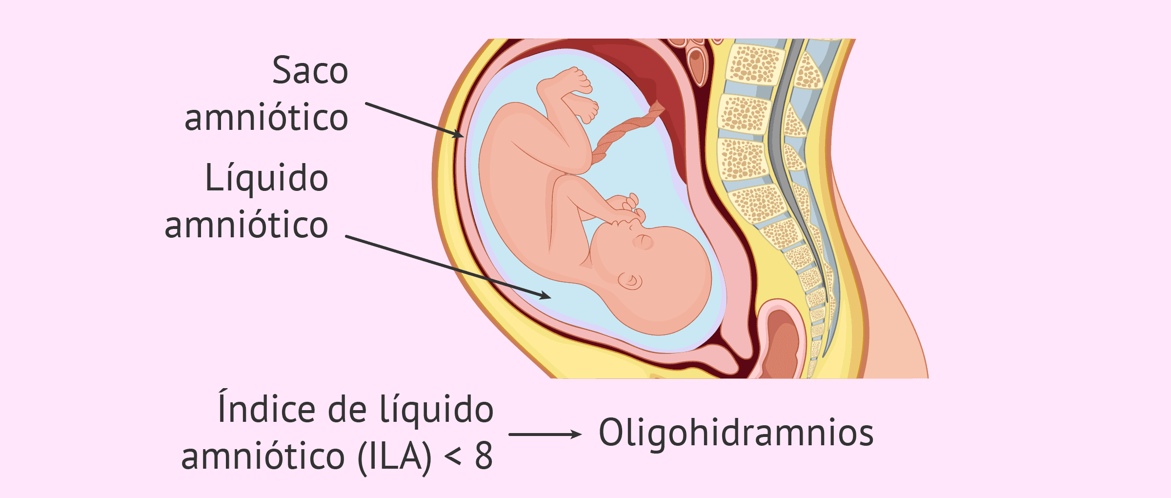 Oligohidramnios: causas, diagnóstico y tratamiento en el embarazo
