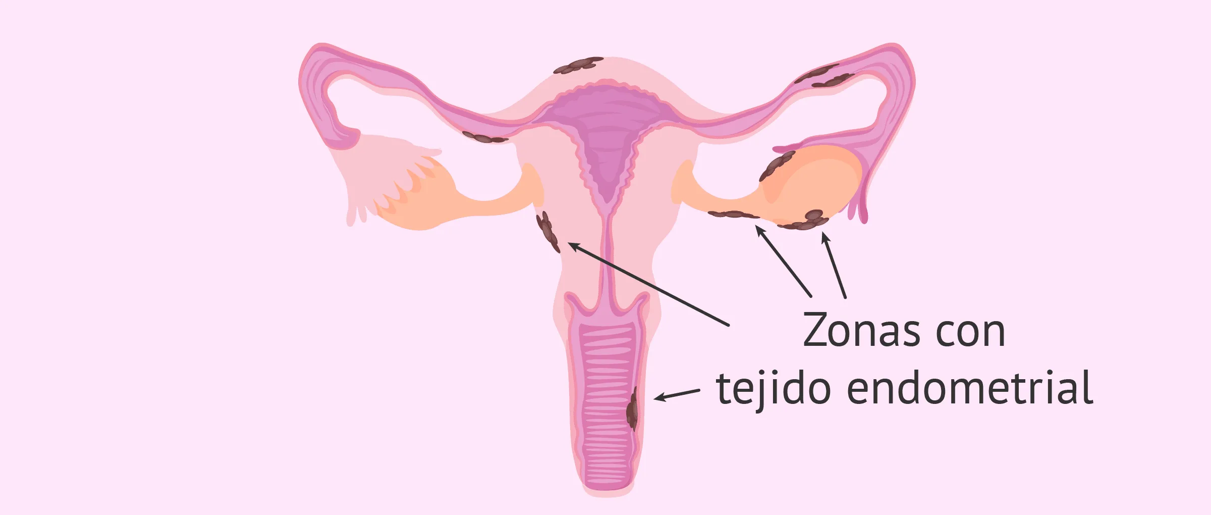 La endometriosis