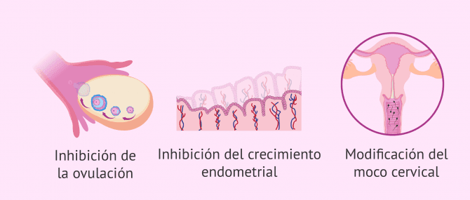 Imagen: Mecanismo de acción del implante anticonceptivo