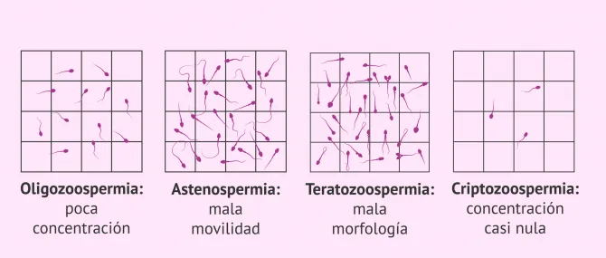Imagen: FIV debido a infertilidad masculina