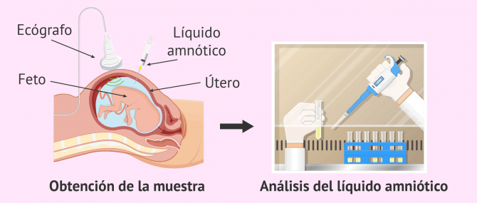 Imagen: Amniocentesis