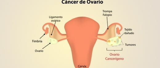 Cáncer y reproducción asistida