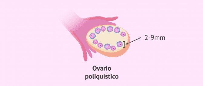 Imagen: ovario-poliquistico-tamano-foliculos