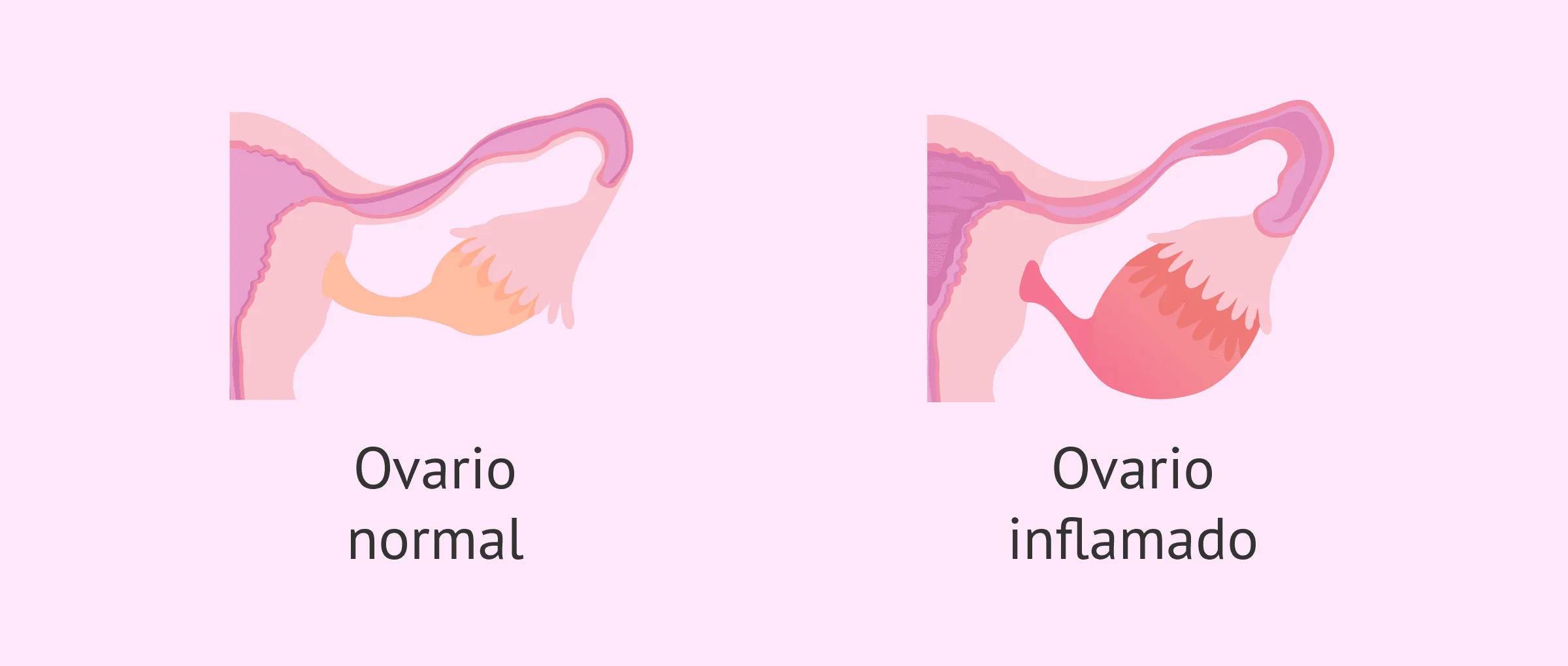 Imagen: Inflamación de los ovarios