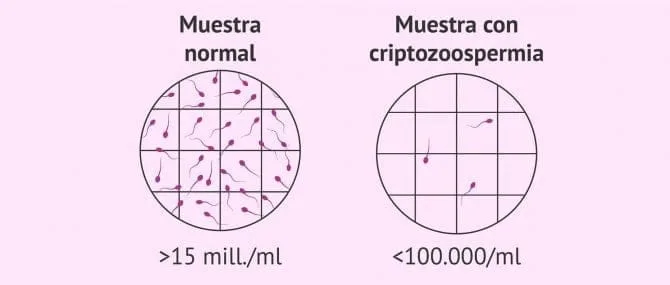 Imagen: Oligozoospermia severa