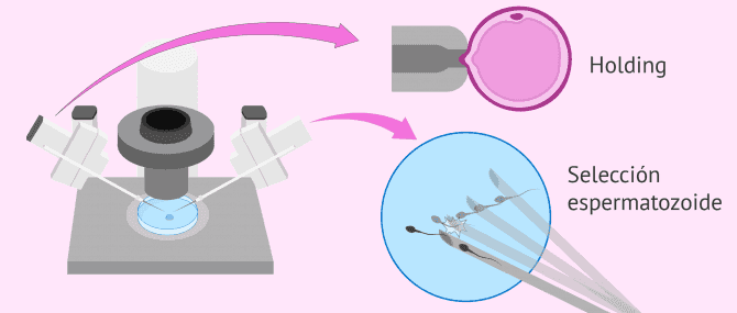 Imagen: Preparación del óvulo y el espermatozoide para la ICSI