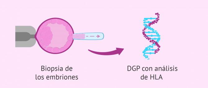 Imagen: Extracción de una célula del embrión