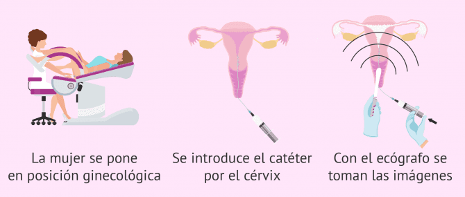 Imagen: ¿Cuál es el procedimiento para la HyCoSy?