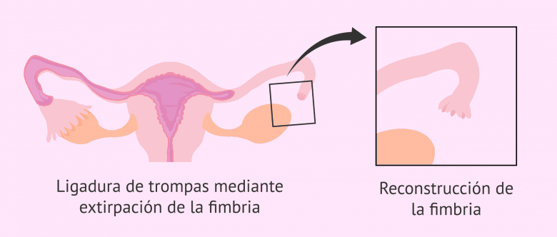 Imagen: Reversión de la ligadura de trompas por reconstrucción de la fimbria