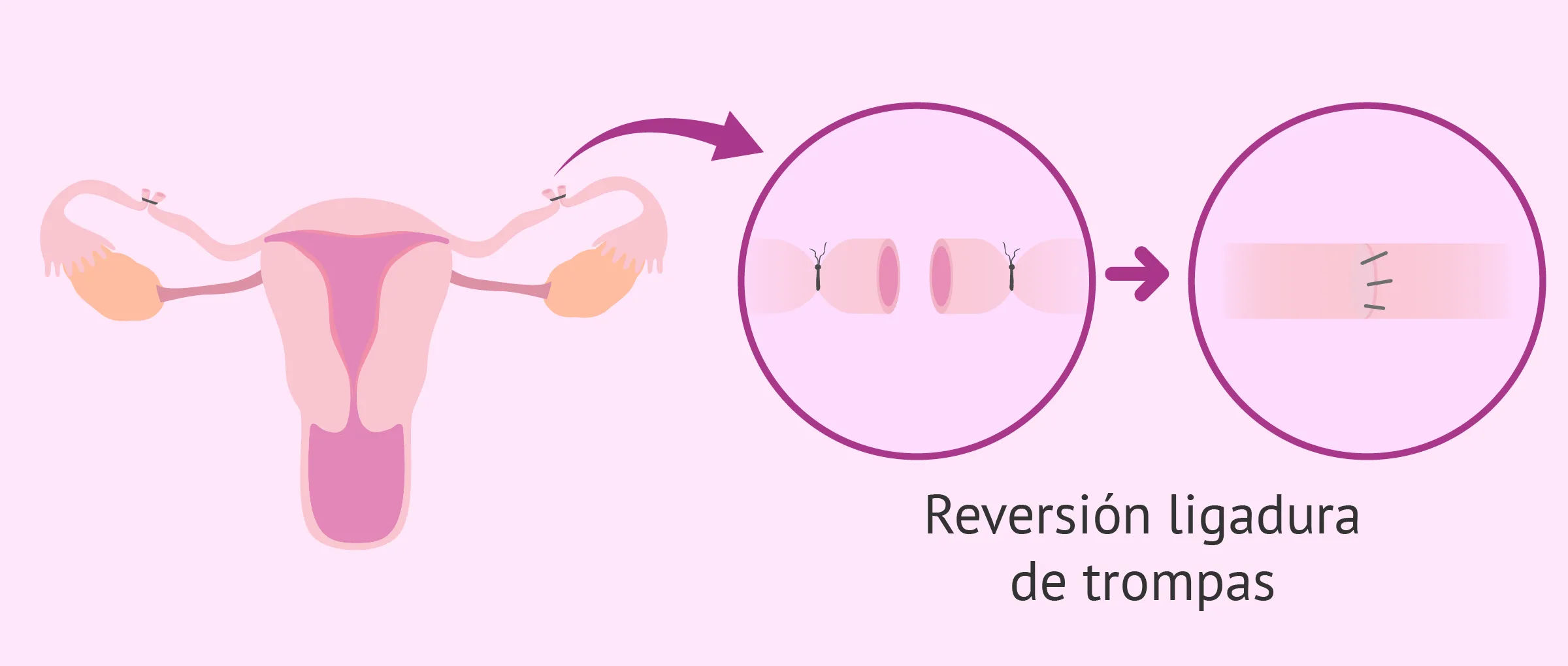 Reversión de la ligadura de trompas