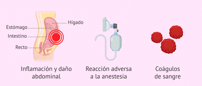 Imagen: Riesgos derivados de la laparoscopia