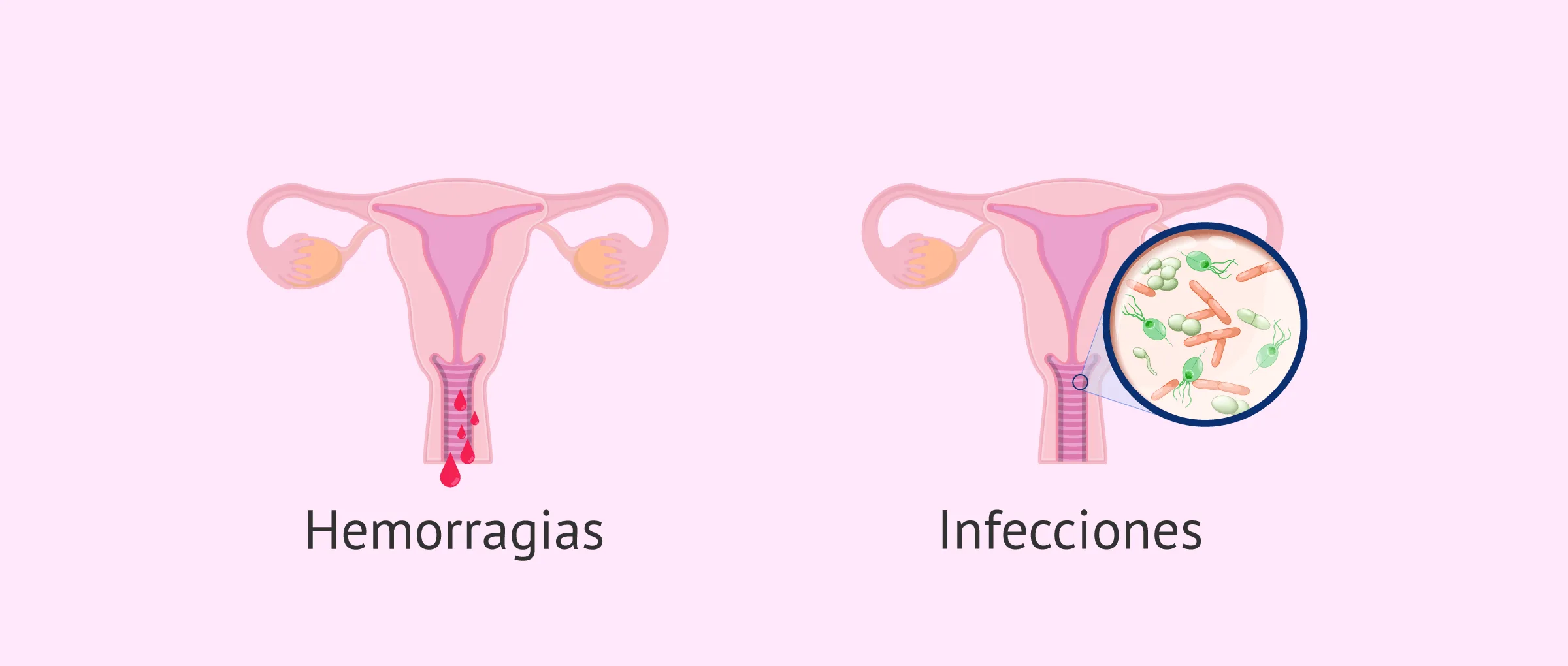 Riesgos de la punción ovárica