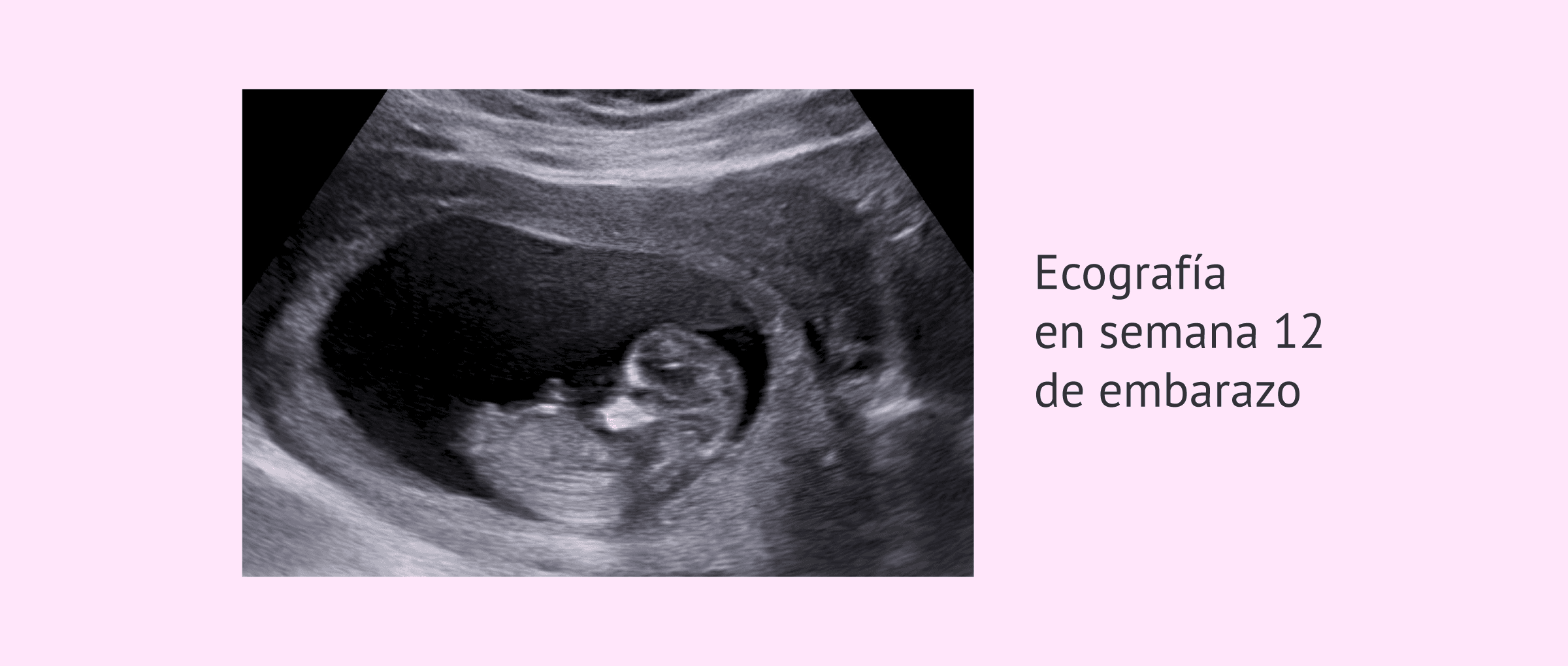 Imagen: Ecografía de un feto de 12 semanas