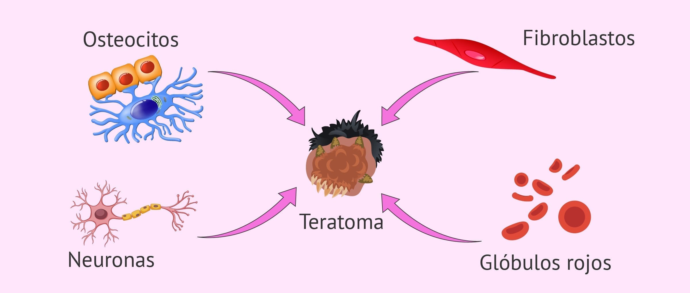 Origen Embrionario Del Teratoma Origen Embrionario Del Teratoma