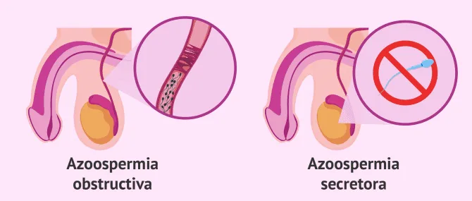 Imagen: Azoospermia secretora y obstructiva