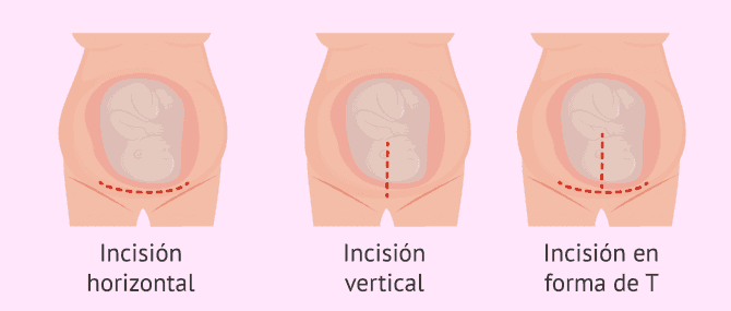 Imagen: Tipos de cesárea