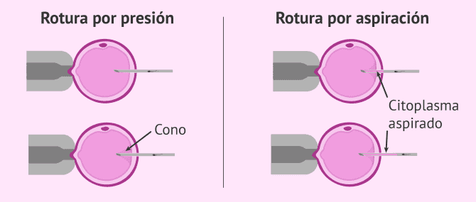 Imagen: Tipos de rotura en una ICSI