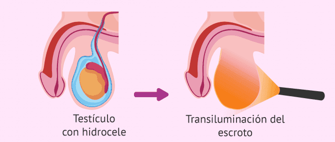 Imagen: La transiluminación del escroto