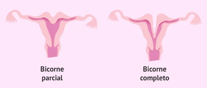 Imagen: Tipos de útero bicorne