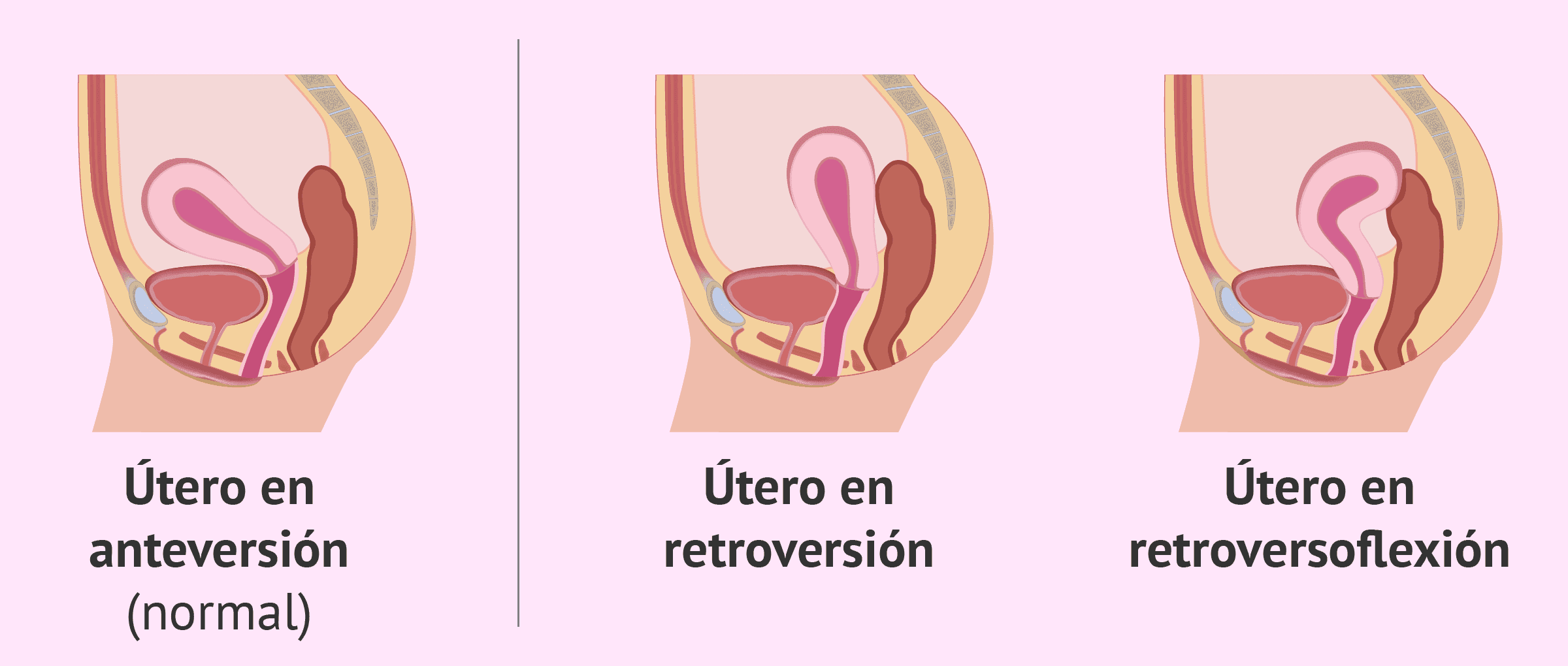 Qué es el útero retroverso? - Causas y síntomas