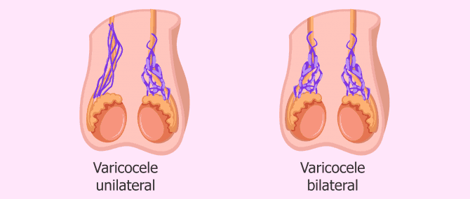 Imagen: tipos de varicocele