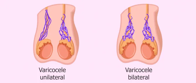 Imagen: tipos de varicocele