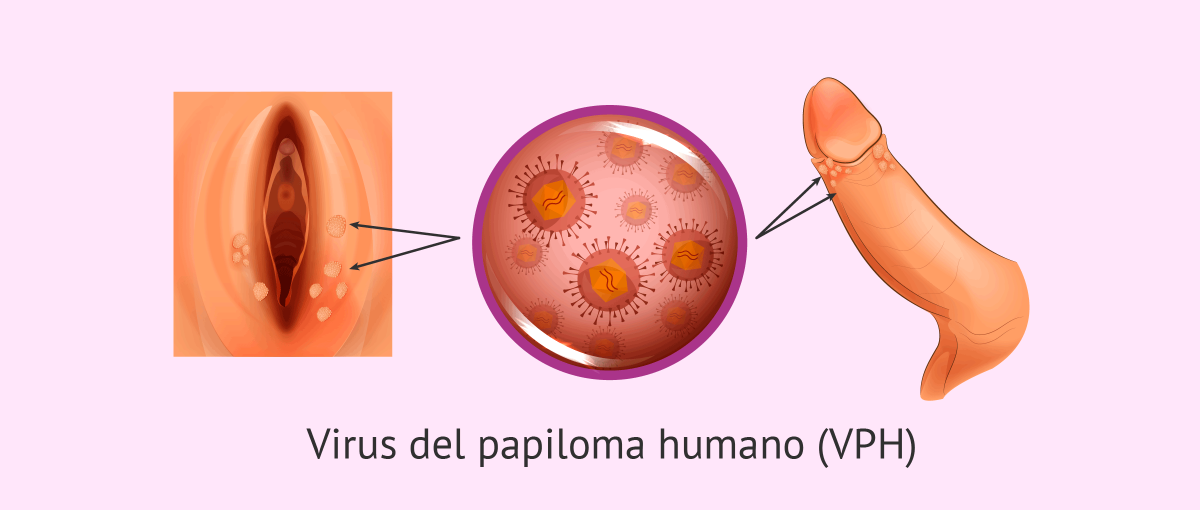 verrugas genitales por vph