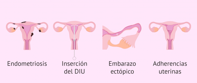 Imagen: ¿Qué puede provocar la aparición de hidrosálpinx?