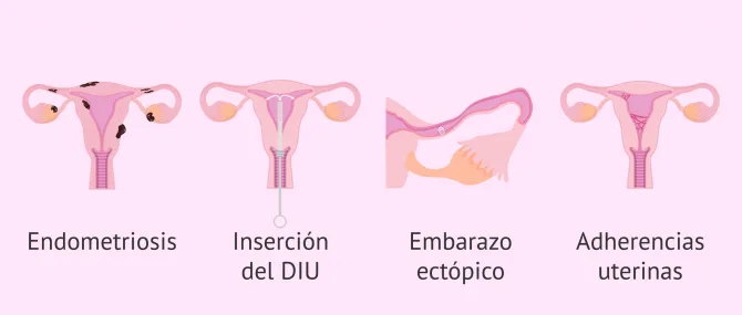 Imagen: ¿Qué puede provocar la aparición de hidrosálpinx?