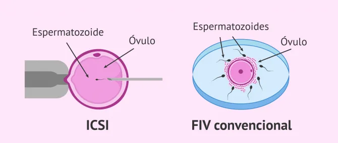 Imagen: Comparación entre la FIV convencional y la ICSI