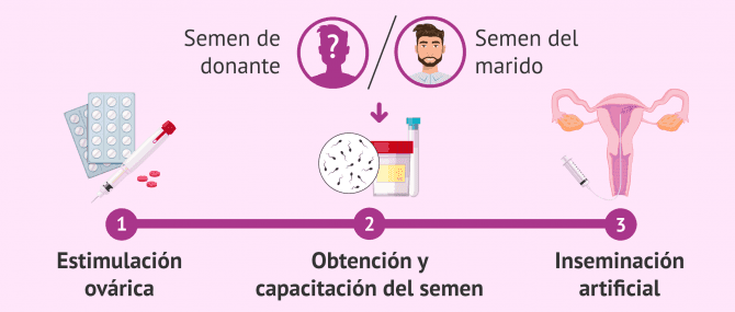 Imagen: Proceso de la IA con semen conyugal o de donante