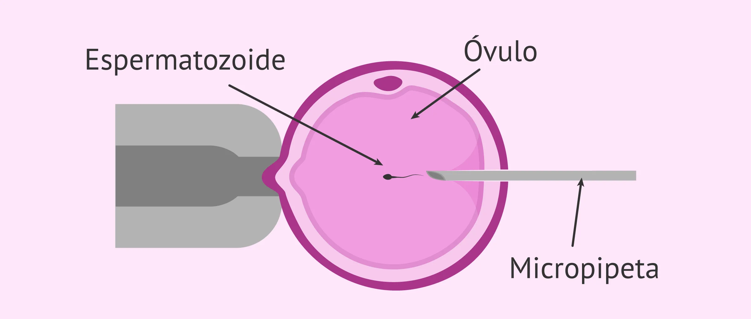 Inyección intracitoplásmica de espermatozoides (ICSI)