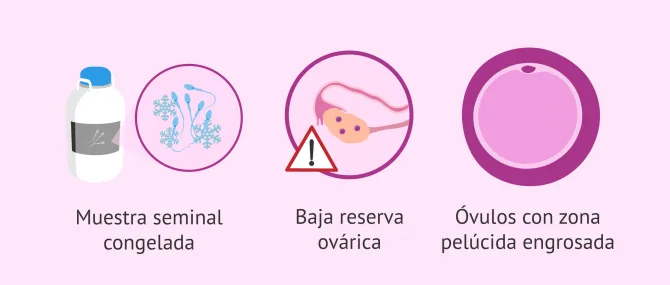 Imagen: Otros casos donde realizar ICSI