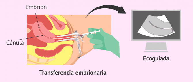 Imagen: Transferencia embrionaria ecoguiada