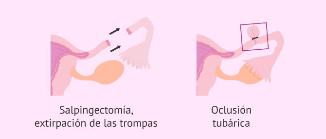 Imagen: Tratamiento quirúrgico del hidrosalpinx