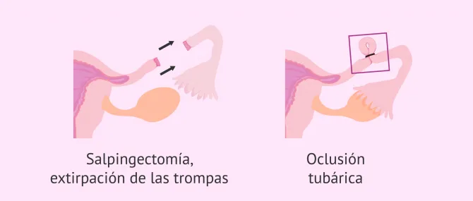 Imagen: Tratamiento quirúrgico del hidrosalpinx