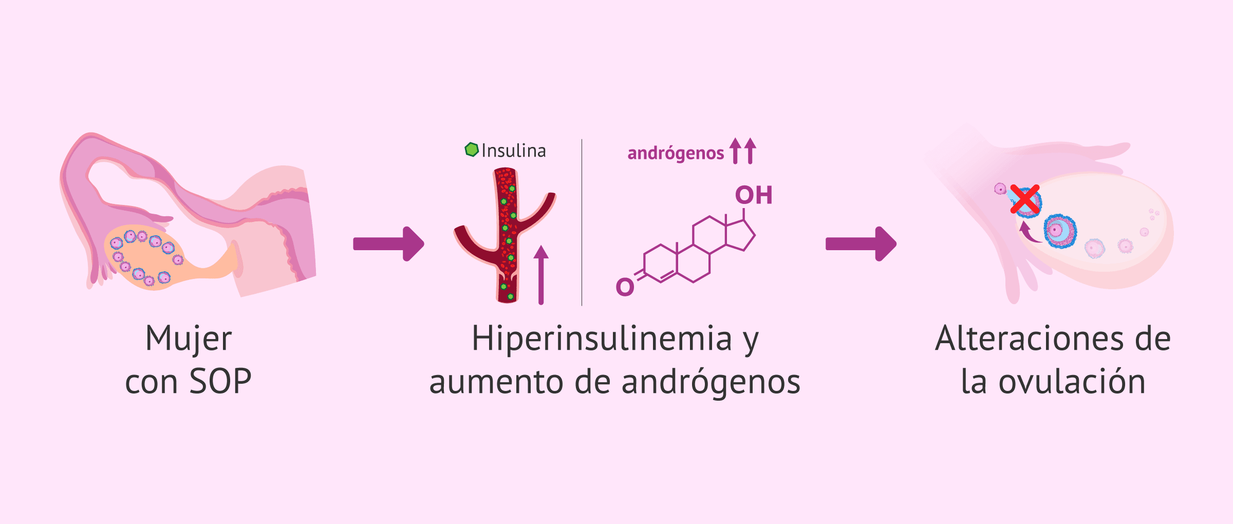Imagen: Mujeres con SOP: hiperinsulinemia, exceso de andrógenos y anovulación