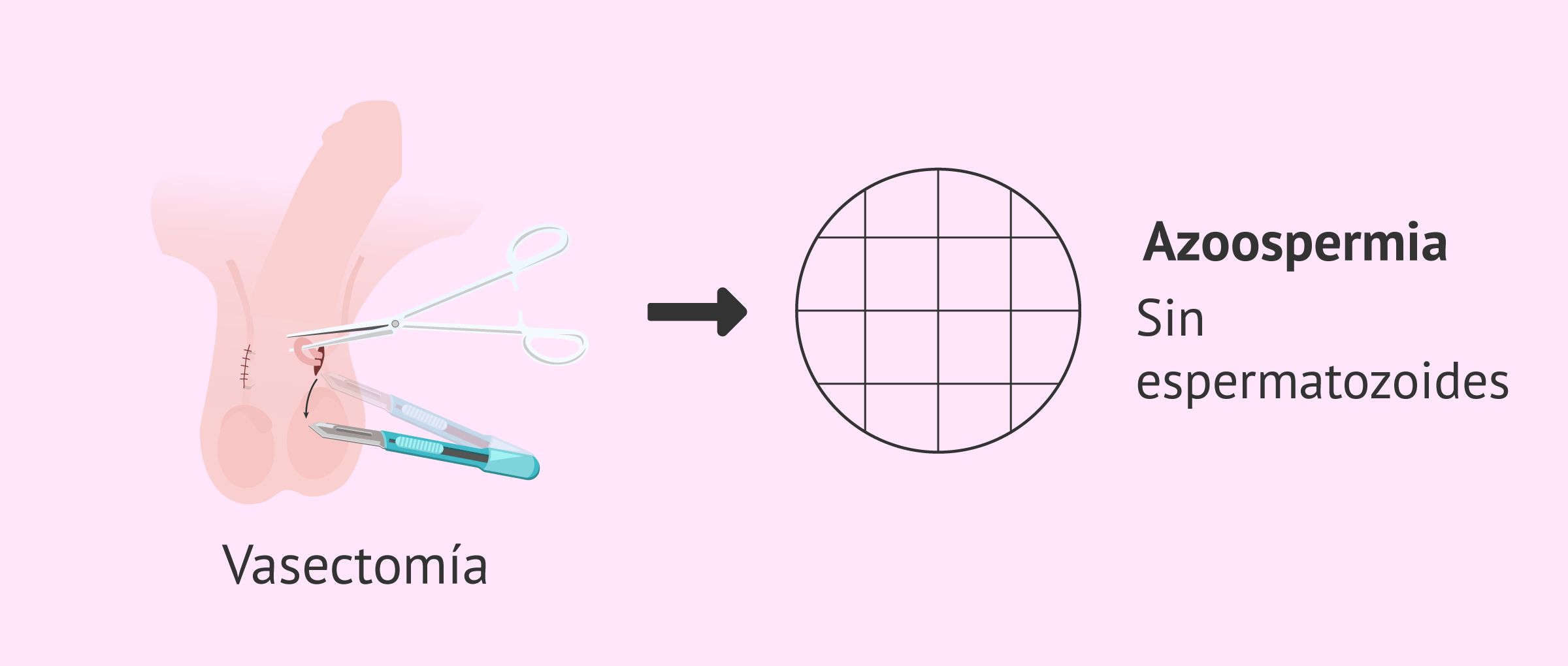 ¿Qué es la PAAF testicular?