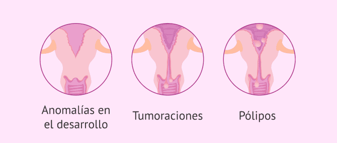 Imagen: Causas de esterilidad por factor cervical