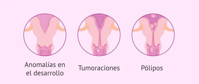 Imagen: Causas de esterilidad por factor cervical